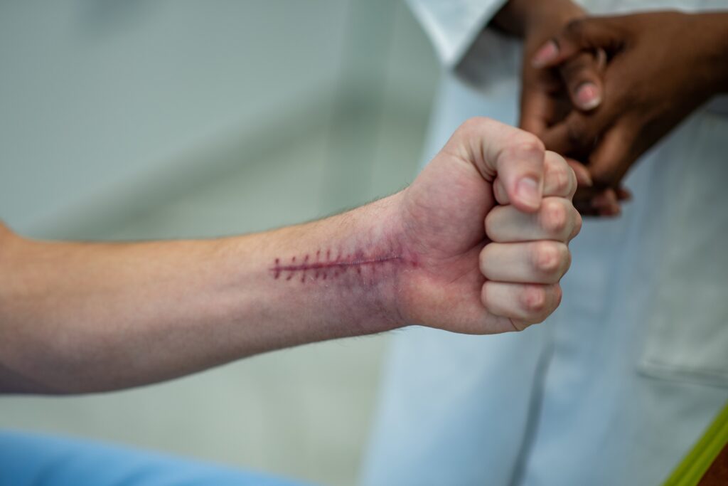 Close-up of a clenched fist showing a fresh surgical scar with stitches on the forearm